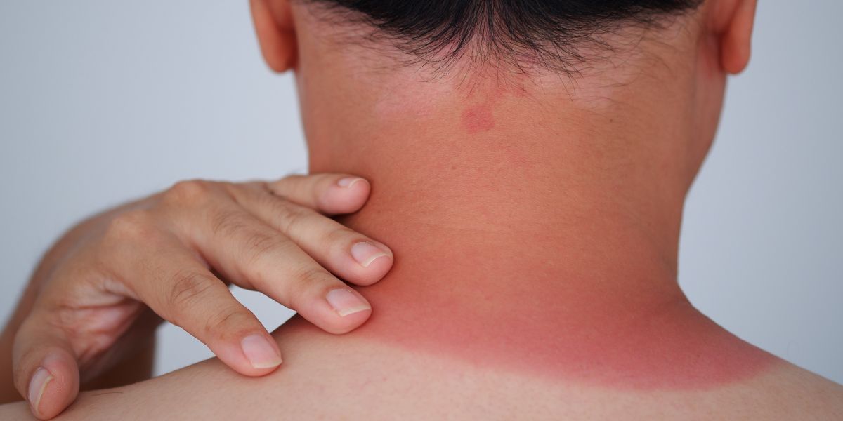 A woman's sunburned neck